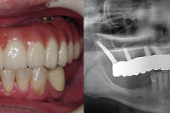 zygomatic-pterygoid-dental-implants-severe-bone-loss-kazemi-oral-surgery-7