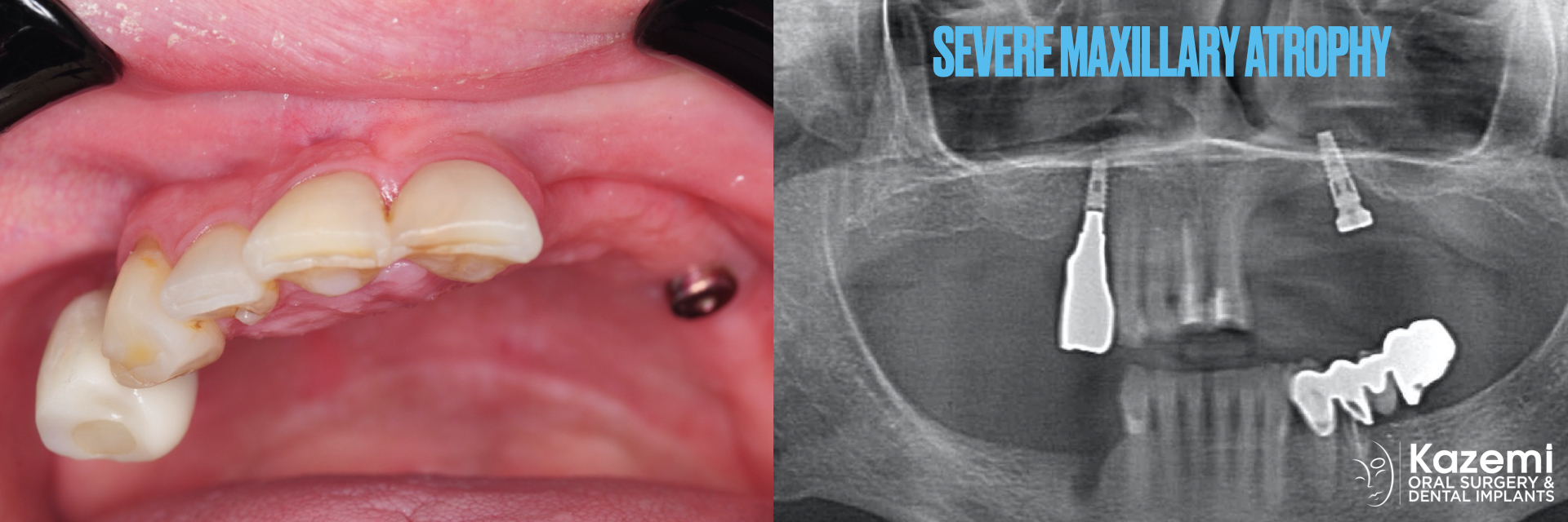zygomatic-pterygoid-dental-implants-severe-bone-loss-kazemi-oral-surgery-2