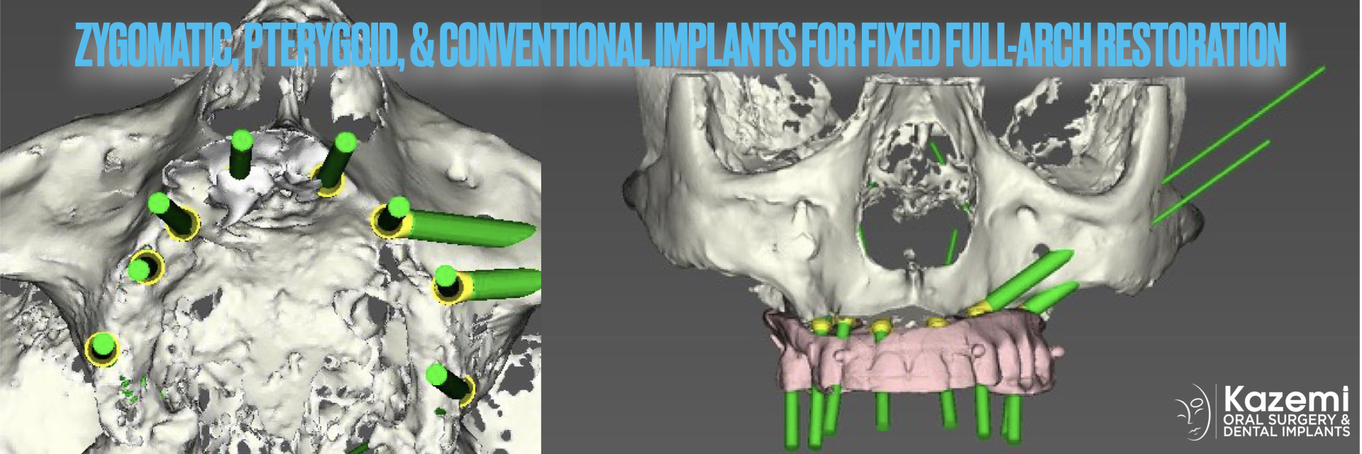 zygomatic-pterygoid-dental-implants-severe-bone-loss-kazemi-oral-surgery-3