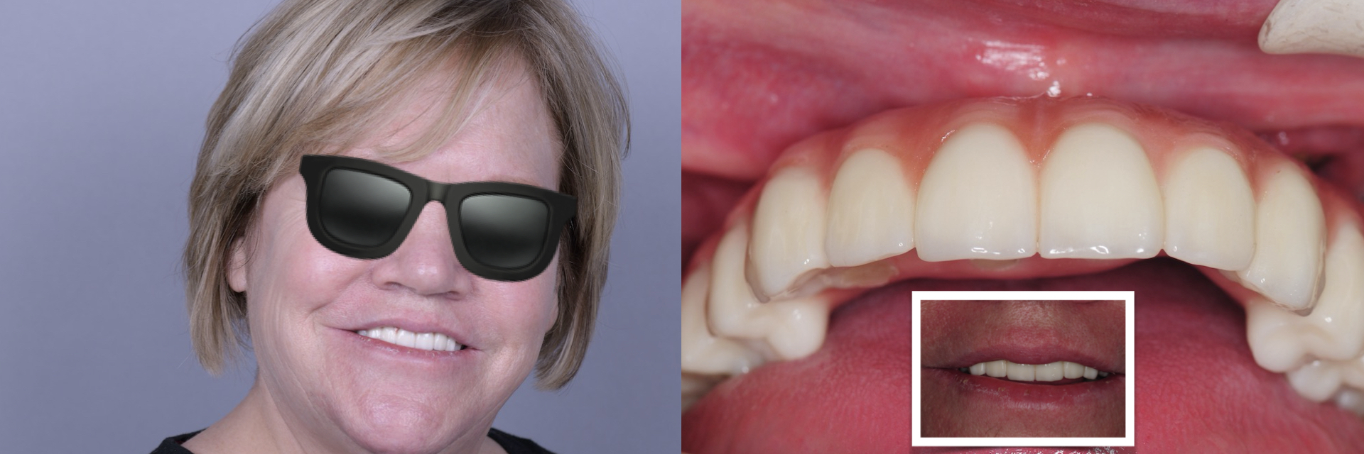 zygomatic-pterygoid-dental-implants-severe-bone-loss-kazemi-oral-surgery-8